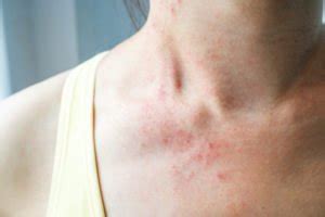 beta alanine skin rash